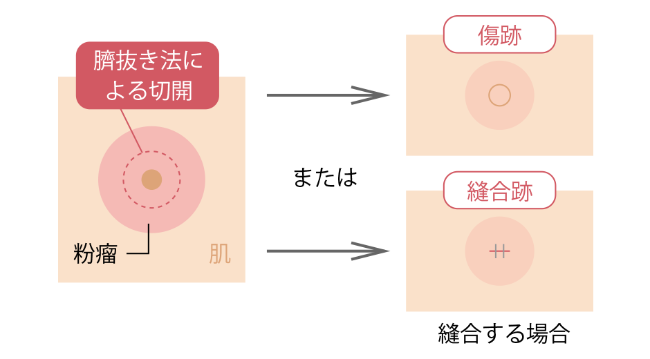 くりぬき法