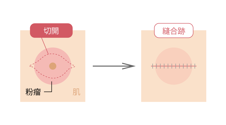 切除縫合術