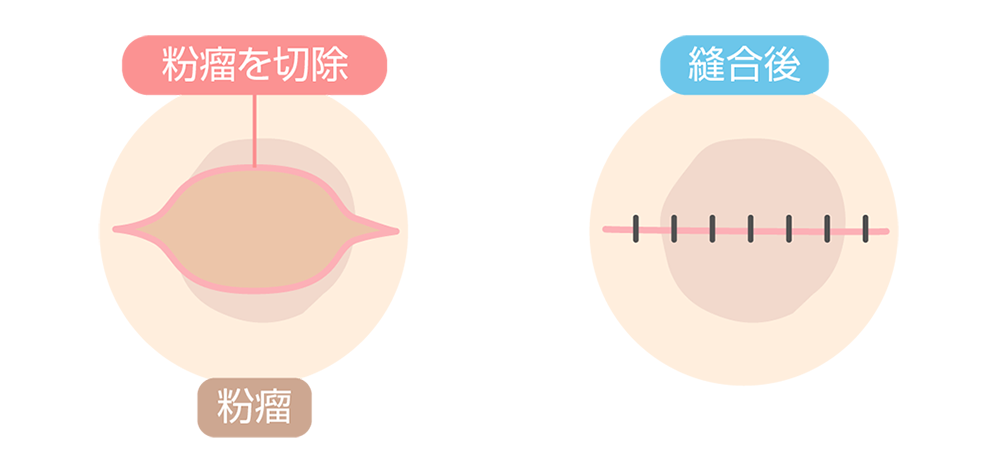 粉瘤の治療方法　イメージ