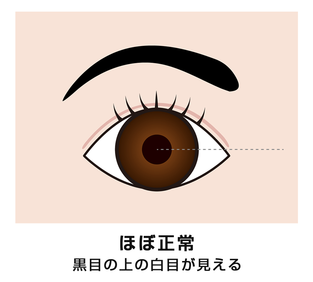 眼瞼下垂（ほぼ正常）　イメージ