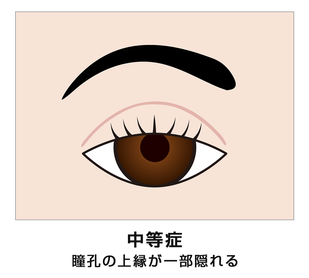 眼瞼下垂（中等症）　イメージ