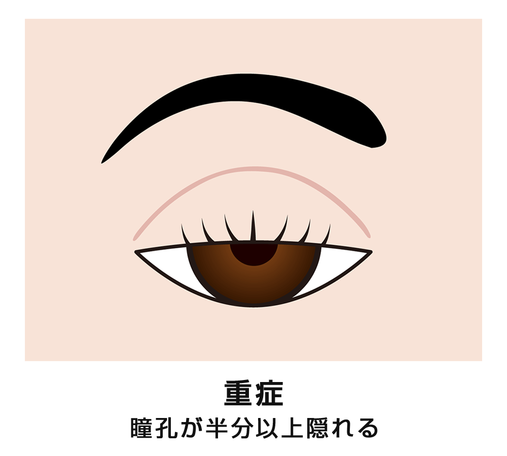 眼瞼下垂（重症）　イメージ