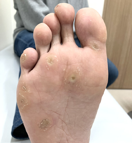 ウイルス性イボ