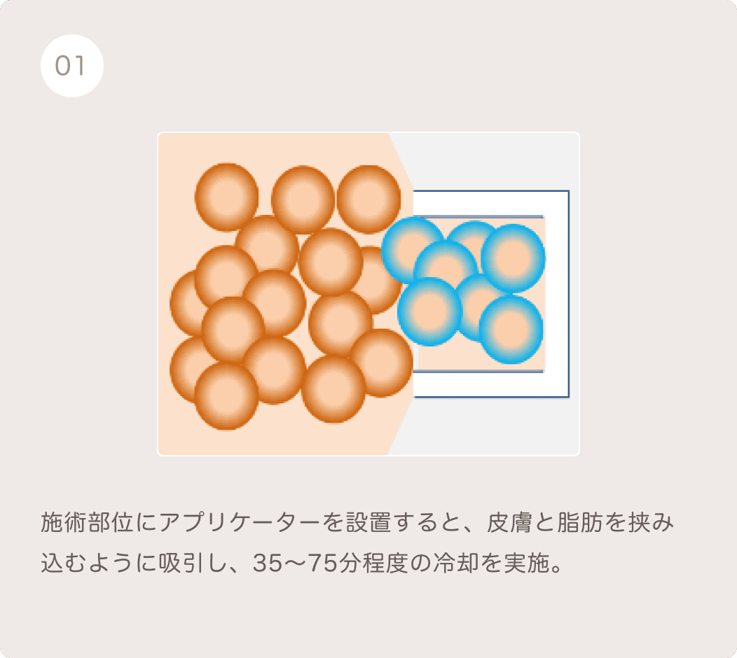 クールスカルプティングの仕組み