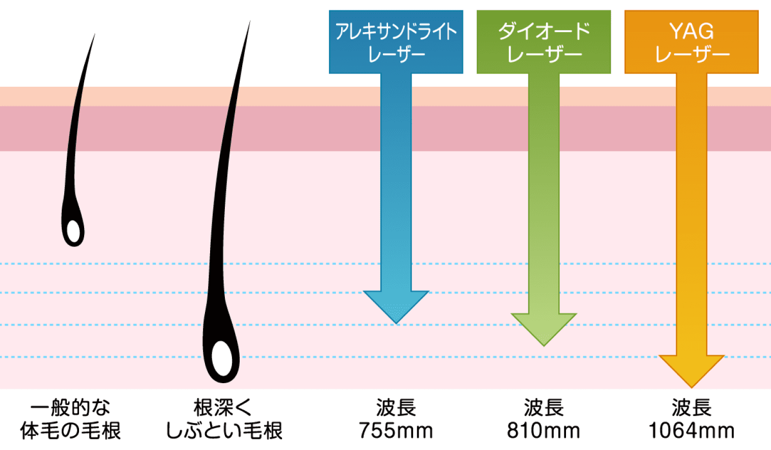 医療脱毛の種類について