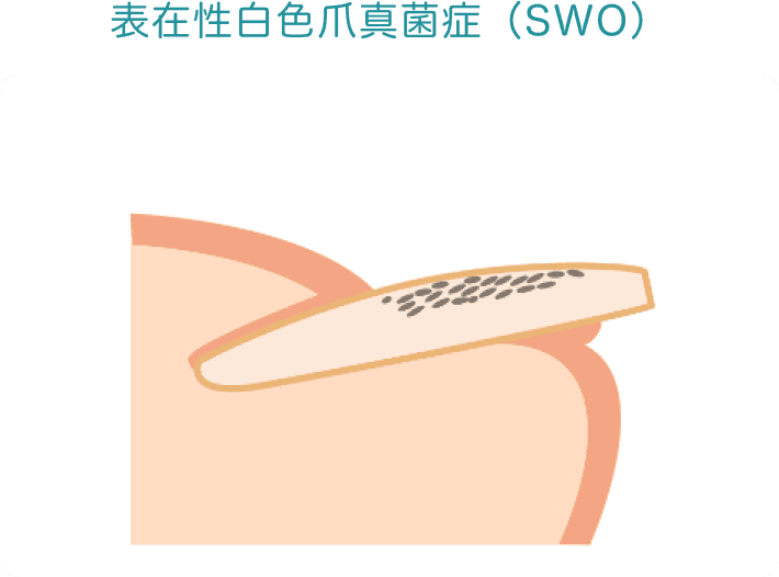 表在性白色爪真菌症（SWO）