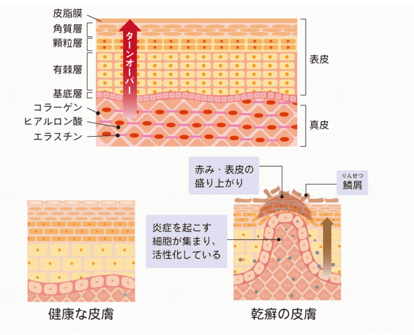 乾癬の症状