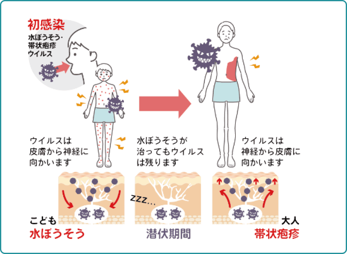 帯状疱疹の原因