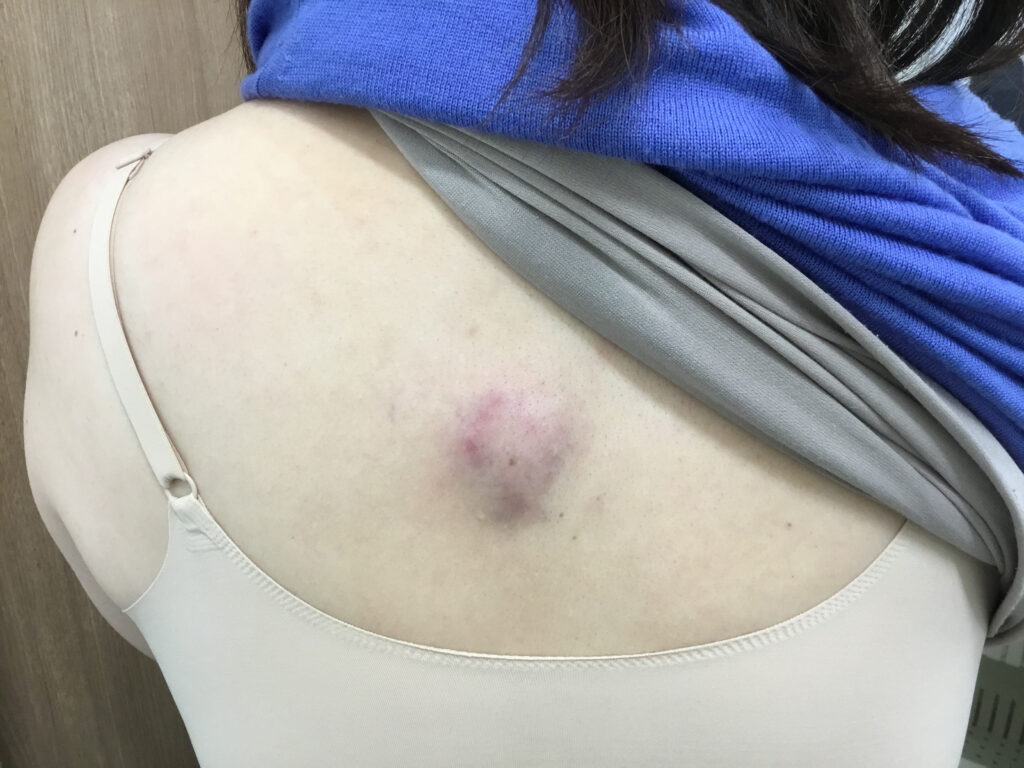 粉 瘤 潰れ た